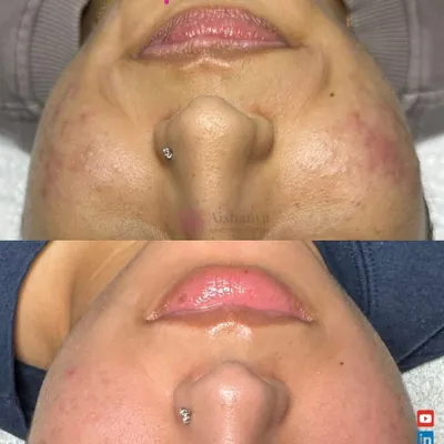 This client was struggling with skin congestion and inflammation. With a consistent, customized treatment plan, we were able to significantly calm her skin, reduce breakouts, and improve the overall texture for this amazing, smooth result.