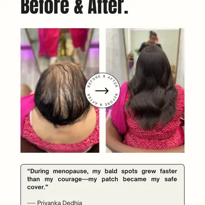 Menopause can bring unexpected changes like rapid hair thinning. For Priyanka, this hair patch became her safe cover, allowing her to face the world with renewed confidence.
