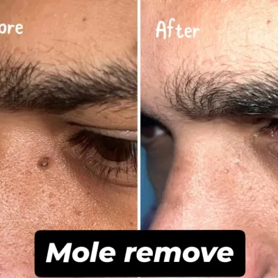 This is a clear demonstration of our safe and precise mole removal procedure. We help you achieve smooth, blemish-free skin with minimal downtime, boosting your confidence.