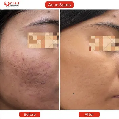 A clear view of a significant reduction in both active acne spots and textured scarring. Our goal is to not only clear current breakouts but also to repair the underlying skin texture for a truly smooth finish.