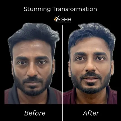 A full-face rejuvenation for this gentleman. We used hyaluronic acid fillers to correct under-eye bags, add volume to flat cheeks, and enhance the lips, transforming a tired look into a confident one.