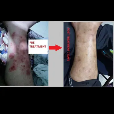 This is a clear example of progress after just seven days of my Ayurvedic treatment. The image shows a significant reduction in inflammation and lesions on the patient's leg, demonstrating how quickly the body can begin to heal with the right approach.