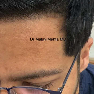 Here you can see a restored hairline that blends flawlessly with the patient's existing hair. The use of single follicular units at the very front and an irregular placement pattern are key to achieving this undetectable result.