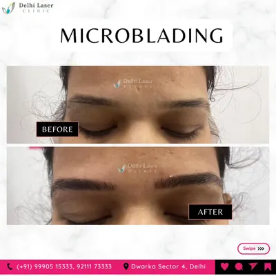 This before-and-after image is a clear example of a microblading transformation. We took sparse, undefined brows and created a fuller, perfectly arched shape that looks completely natural and enhances the eyes.