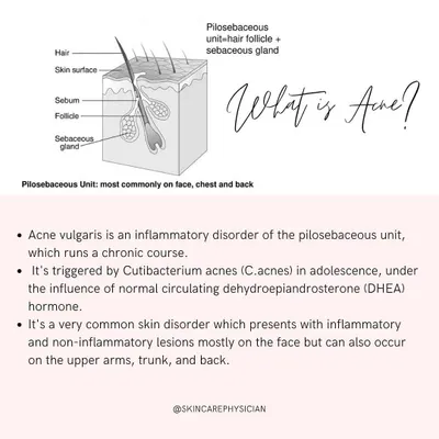 To effectively treat acne, we first need to understand what it is. This visual explains the pilosebaceous unit, the part of your skin where acne, an inflammatory disorder, begins.