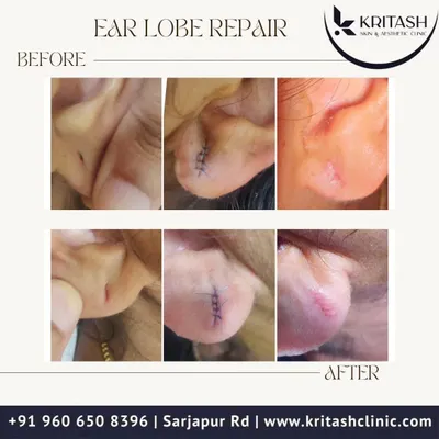 This before and after collage shows the complete journey of an earlobe repair. You can see the initial tear, the precise sutures immediately after the procedure, and the clean, healed result. It's a quick and effective in-clinic treatment I perform for split earlobes, often caused by heavy earrings or accidents.
