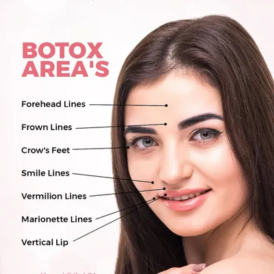 This diagram shows the specific areas where Botox can be most effective. I precisely target muscles that cause forehead lines, crow's feet, and smile lines to create a smoother and more youthful appearance without affecting your natural expressions.