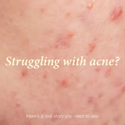 If you are struggling with acne, it is important to seek professional guidance. A real diagnosis and tailored plan are the first steps toward clear skin.