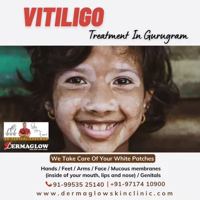 We offer specialized care for vitiligo, addressing white patches that can appear on the hands, feet, face, and other areas. Our clinic provides expert dermatological treatments to help manage the condition and support our patients.
