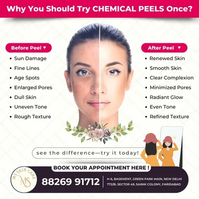 This graphic clearly shows the transformative effects of a chemical peel. It's an excellent treatment for sun damage, fine lines, and uneven tone, revealing renewed, smoother, and more radiant skin.