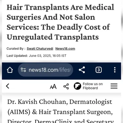 A screenshot of my interview with News18, where I emphasized that hair transplants are serious medical surgeries, not simple salon services, and stressed the importance of choosing a qualified surgeon.