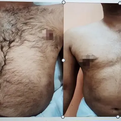 A clear before-and-after comparison of male chest hair reduction. These results were achieved after just 4-5 sessions, demonstrating the effectiveness of the treatment.