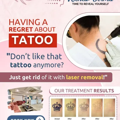 This chart explains the tattoo fading process. We'll create a personalized plan for you, but this gives you an idea of how the ink lightens with each laser session, typically spaced weeks apart to allow for healing.