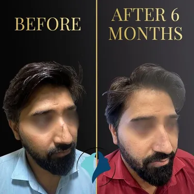 A clear before and after of a surgical nose scar revision. The initial photo shows a depressed and visible scar, while the photo taken six months later shows significant improvement in skin texture and a far less conspicuous mark.