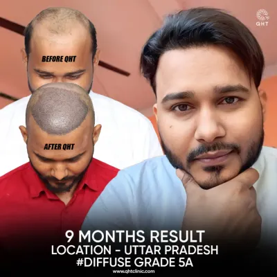 A fantastic 9-month result for a patient from Uttar Pradesh with Diffuse Grade 5A hair loss. The image collage displays the 'before' state, the scalp immediately 'after' the 5000-graft procedure, and the impressive final outcome.