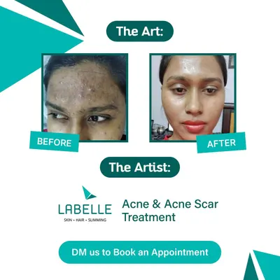 We see your skin as a canvas and our treatments as the art. This client's journey shows a significant reduction in acne and scarring, resulting in a masterpiece of clear, smooth skin.