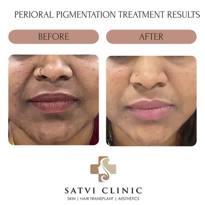 A clear example of improvement in perioral melanosis. Treatment involved a combination of topical therapy and patient education on avoiding triggers like friction and excessive sun exposure. Consistency is crucial for managing pigmentation disorders effectively.