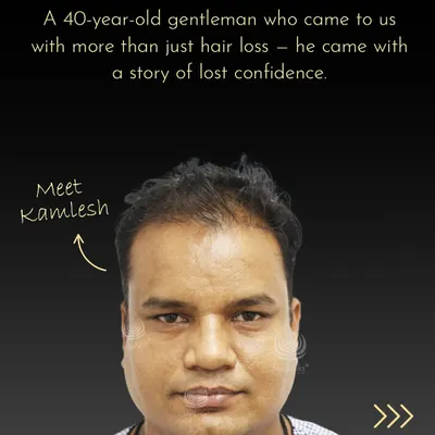 Meet Kamlesh, who came to us with thinning hair and lost confidence. This before-and-after shows his incredible transformation with our I-Hair Restoration protocol, proving it's never too late to feel like yourself again.