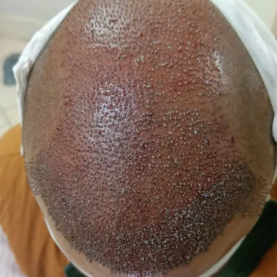 This is the immediate result after a 10,000-graft hair transplant. You can see the density and the precision of the placement, which is key to achieving a full, natural look once the hair grows in.