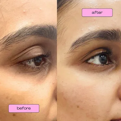 A clear example of how under-eye fillers can make a significant difference. We used just 0.4ml of hyaluronic acid filler under each eye to correct hollowness and reduce the appearance of dark circles, resulting in a naturally refreshed look.