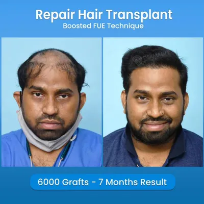 This is a 7-month result of a repair hair transplant. We implanted 6000 grafts using the Boosted FUE technique to correct a previous procedure, achieving a full and natural-looking hairline.