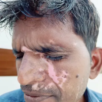 This patient has Vitiligo patches on the face, an area that can cause a lot of stress. My treatment focuses on carefully restoring pigment to these visible areas.