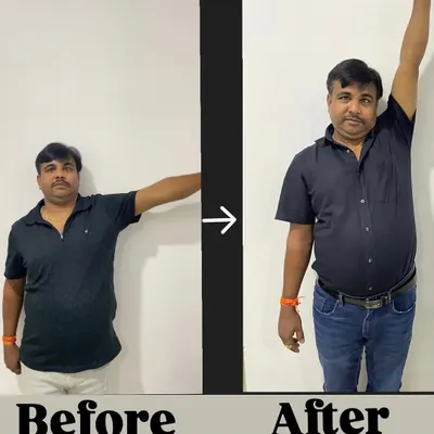 Before and After: Mr. Hukum, age 48, came to us with a severe frozen shoulder, limiting his daily activities. After dedicated therapy, he achieved a full, pain-free range of motion.