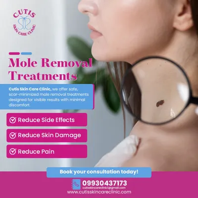 If you're concerned about a mole, our treatments are designed for your peace of mind. We focus on scar-minimized procedures that reduce side effects, skin damage, and pain, all under expert dermatological supervision for visible, safe results.