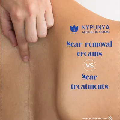 A question I get all the time is whether scar removal creams are as effective as in-clinic scar treatments. The answer depends on the type and depth of your scar.
