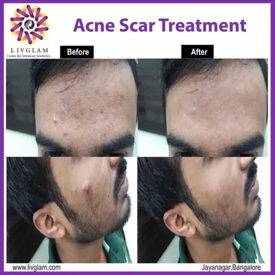 A powerful example of our acne scar treatment for men. The 'after' image demonstrates a dramatic reduction in scar depth and texture, leading to smoother skin on the forehead and cheek.