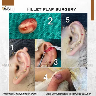 This collage shows the key steps of an earlobe keloid removal using a fillet flap surgery technique. This method allows for complete removal of the keloid tissue with a very low chance of recurrence.