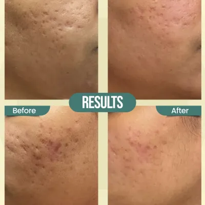 These before-and-after photos showcase the significant improvement in deep acne scars after a course of advanced treatments. By combining therapies like Subcision with RF and Exosome Therapy, we can release tethered scars and rebuild collagen for a smoother skin surface.