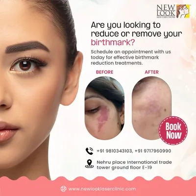 This before and after image shows the significant reduction of a vascular birthmark. Our treatments are designed to progressively lighten such marks over a series of sessions, leading to clearer skin and renewed confidence.