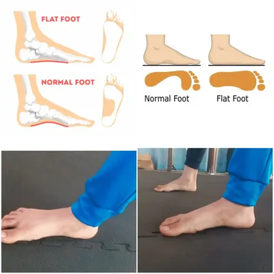 We actively work on fixing biomechanical issues. This image explains how we identify flat feet and use specific, guided exercises to correct the arch, improving overall posture and preventing long-term leg problems.