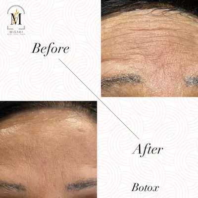 This before and after photo clearly shows the power of Botox in smoothing away deep forehead wrinkles. The result is a much smoother, more youthful appearance while maintaining a natural look.