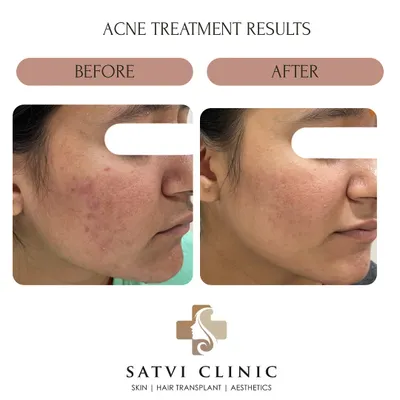 This patient's transformation shows a significant reduction in active, inflammatory acne. This progress was achieved through a consistent, guided treatment plan, proving that with patience and the right approach, clear skin is attainable.
