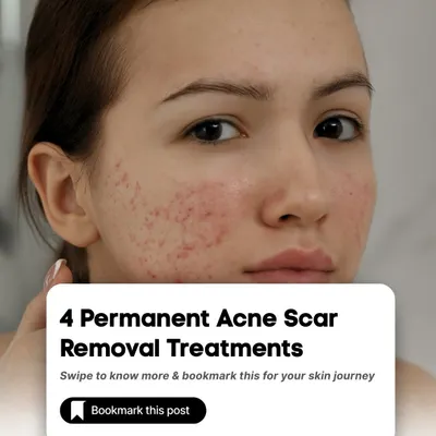A starting point for anyone looking to understand their options for permanent acne scar removal. I offer a range of treatments because every scar type requires a different approach.