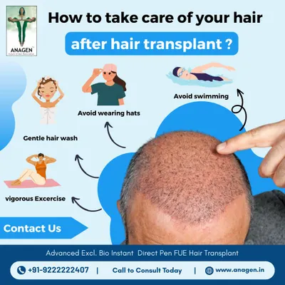 Taking care of your hair after a transplant is crucial for the best results. This infographic provides key tips, such as gentle hair washing and avoiding vigorous exercise, swimming, and wearing hats in the initial period.