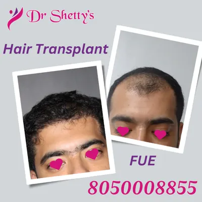 This before and after image shows a clear transformation achieved with the FUE hair transplant technique. My focus is on strategic follicle placement to recreate a hairline that looks completely natural and provides excellent density.