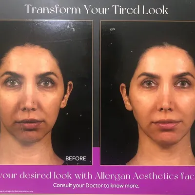 A tired look is often caused by volume loss in key areas of the face. With strategically placed facial fillers, I can restore that volume and help you achieve a naturally refreshed and vibrant appearance.