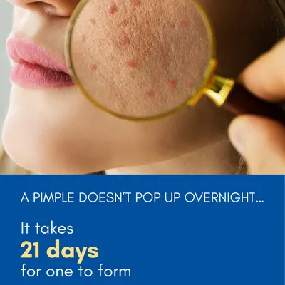 A pimple doesn't just show up overnight. This graphic shows the start of a 21-day process that happens beneath the skin. Understanding this timeline is the first step toward effective and early treatment.