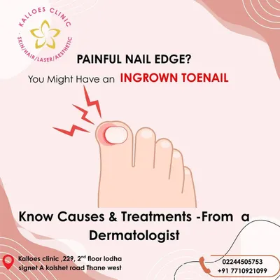 A painful edge on your toenail is a classic sign of an ingrown nail. This graphic explains the issue, which I can diagnose and treat in my clinic to prevent infection and provide immediate relief from discomfort.