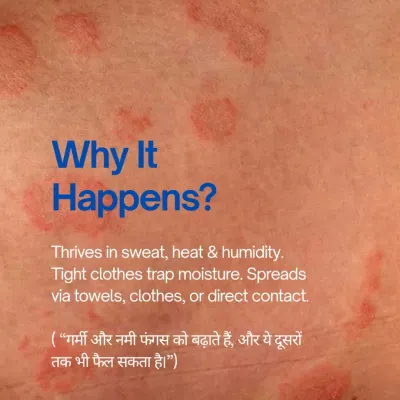 Fungal infections thrive in sweat, heat, and humidity, which is why they are so common. They can spread through shared towels or direct contact, so proper hygiene and treatment are key.
