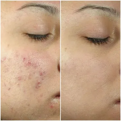 This is a powerful before and after transformation for one of our patients struggling with severe acne and post-inflammatory erythema. Our customized chemical peel treatment plan significantly cleared the breakouts and improved skin texture, revealing healthier skin.
