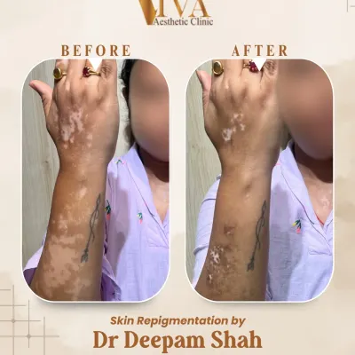 Many people believe vitiligo cannot be treated, but this before and after photo shows what is possible. For this patient, we focused on repigmenting the white patches on her arm and hand. Through a customized medical approach, we successfully restored a significant amount of her natural skin color.