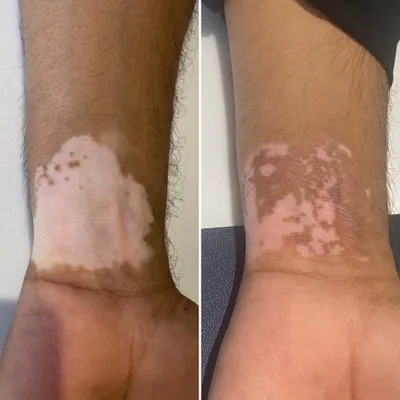 This before and after shows the repigmentation progress on a patient's wrist just six weeks after a Melanocyte Transplantation procedure. This surgical technique is an excellent option for stable Vitiligo, where we transplant healthy pigment-producing cells to the affected areas to restore skin color.