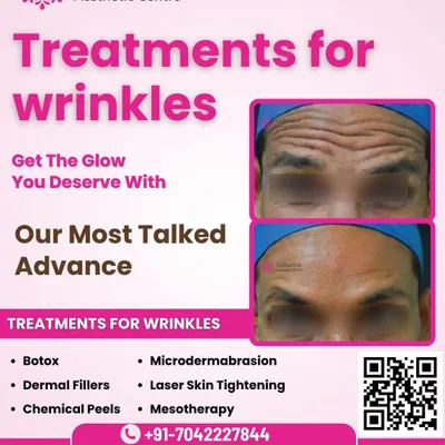 This before-and-after result shows the effective treatment of deep forehead wrinkles. By precisely targeting the underlying muscles, I can smooth these lines, giving you a significantly younger and more relaxed appearance.