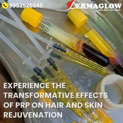 A close-up of the equipment used for our PRP treatments. This image shows vials of separated plasma and prepared syringes, highlighting the clinical and precise nature of this advanced skin and hair rejuvenation procedure.