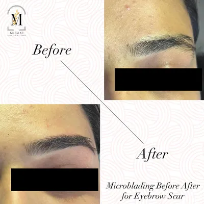 If you have scanty eyebrows or a scar, microblading is the answer. This before and after shows how I can create full, natural-looking brows that frame the face beautifully.