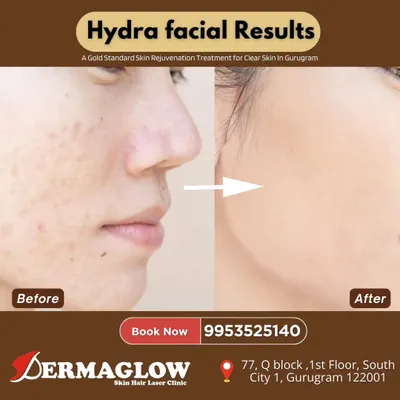 A clear before and after comparison showcasing the results of a HydraFacial. The 'after' photo displays a significant improvement in skin clarity and texture, with reduced blemishes and a brighter, more even skin tone.